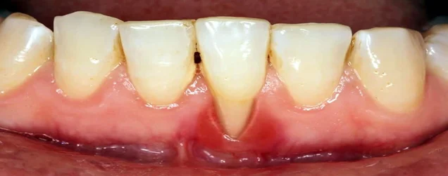 Chữa nha chu tại nhà: Biện pháp hỗ trợ hiệu quả và dễ thực hiện